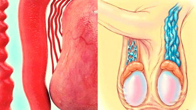 دوالي الخصية: ماهي أعراض دوالي الخصيةوأسبابها وطرق علاجها ؟ طبيبك