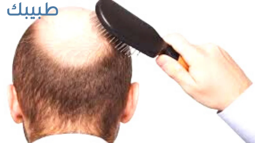 علاج تساقط الشعر عند الرجال بالأعشاب